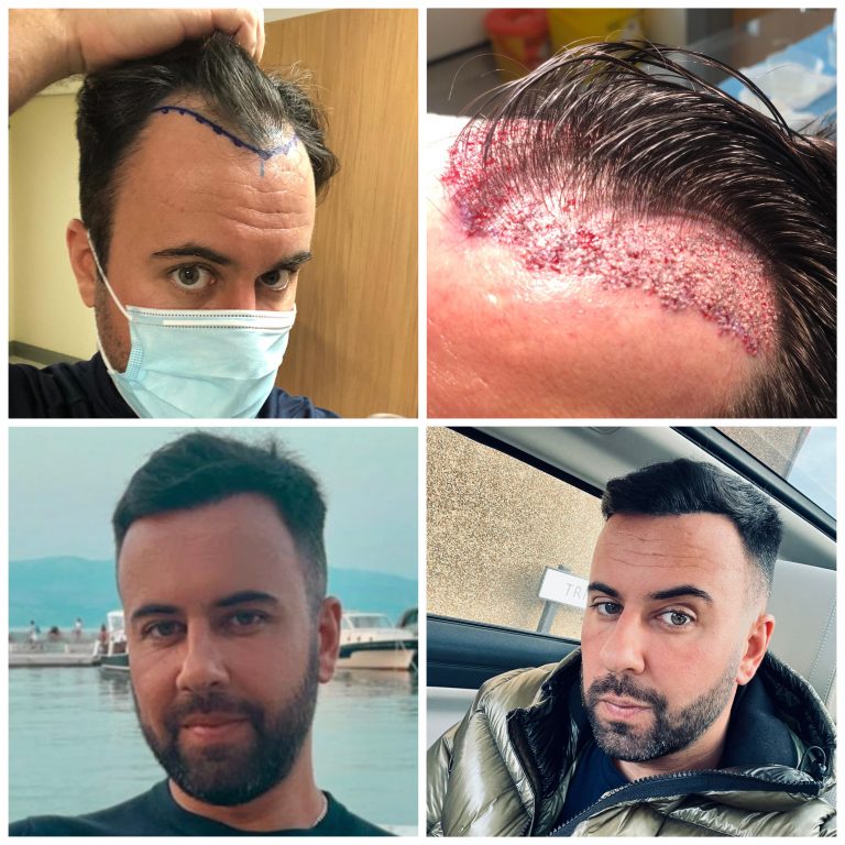 Surgery Group Hair Transplant Patient B