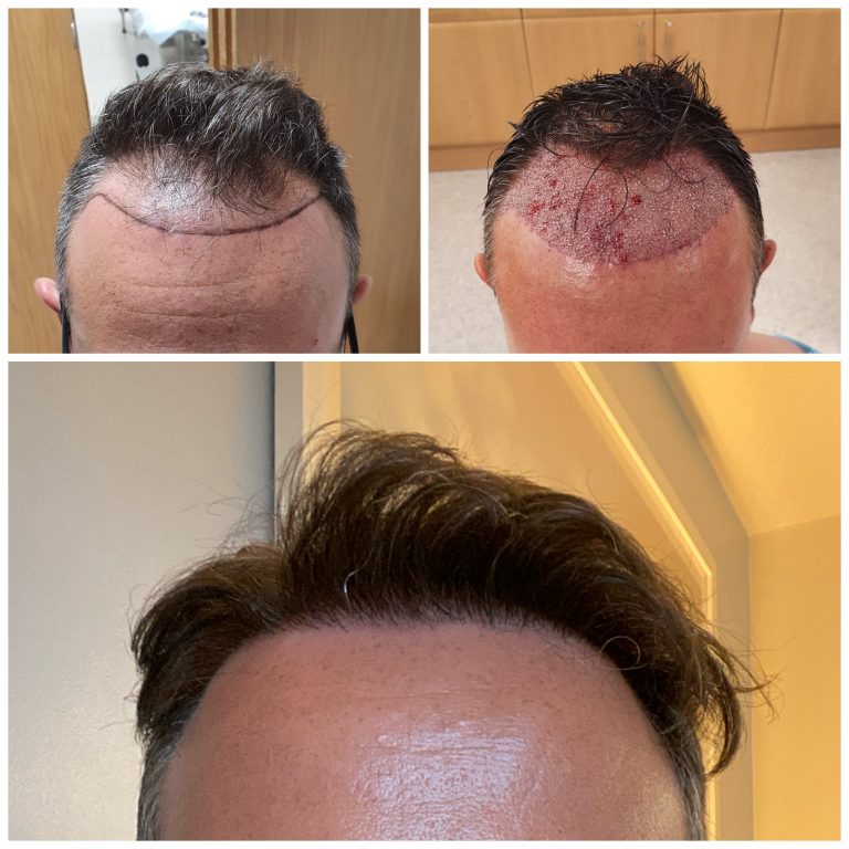 Surgery Group Hair Transplant Patient C