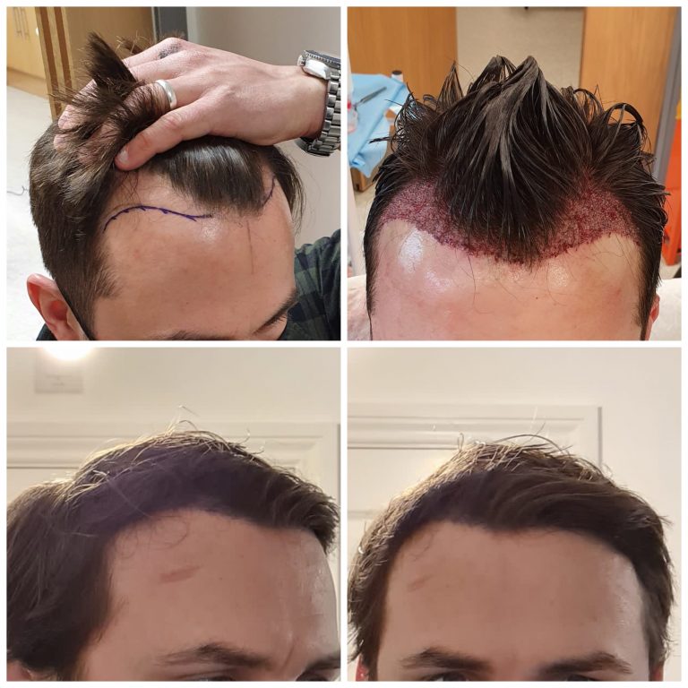 Surgery Group Hair Transplant Patient D