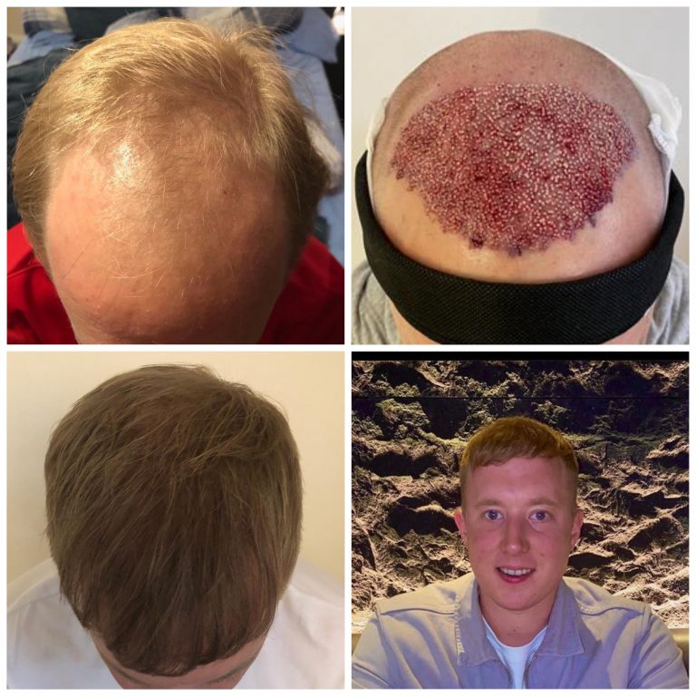 Surgery Group Hair Transplant Patient E