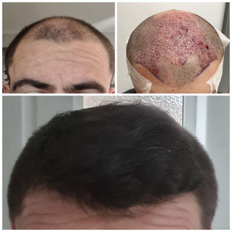 Surgery Group Hair Transplant Patient F