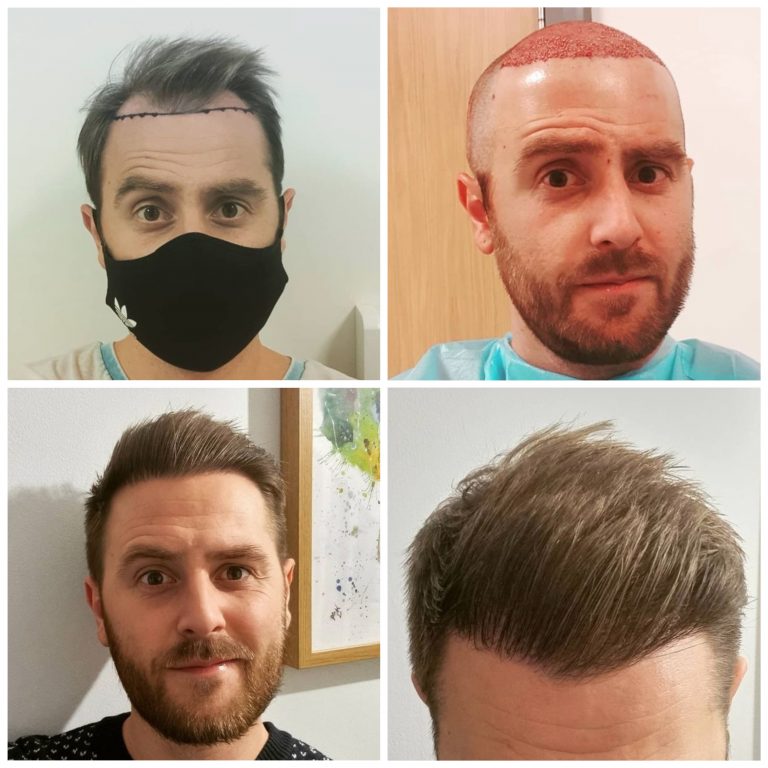 Surgery Group Hair Transplant Patient G