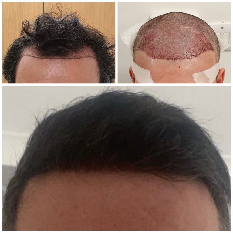 Surgery Group Hair Transplant Patient H