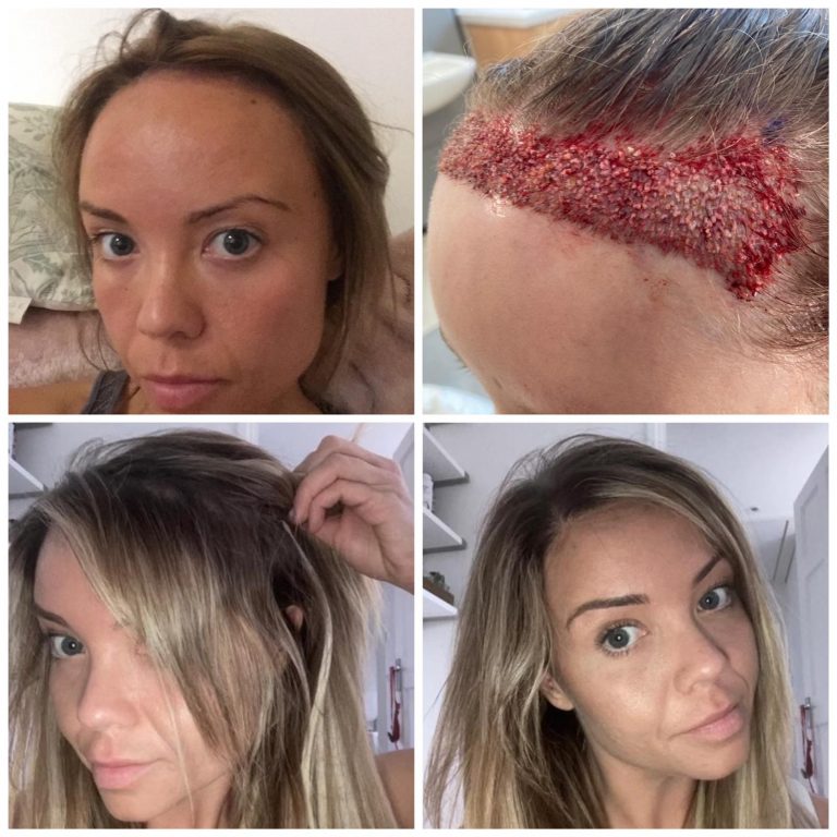 Surgery Group Hair Transplant Patient K