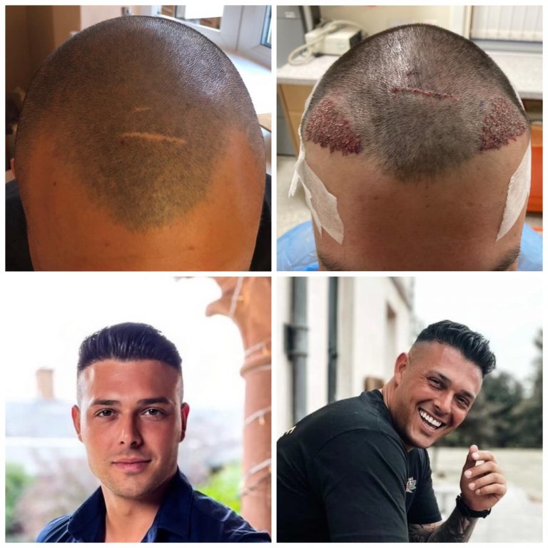 Surgery Group Hair Transplant Patient L